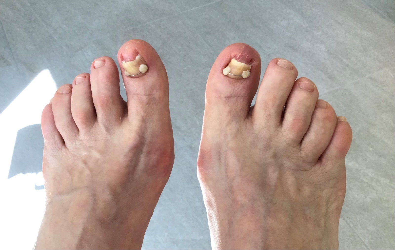 Nagelbeugel
